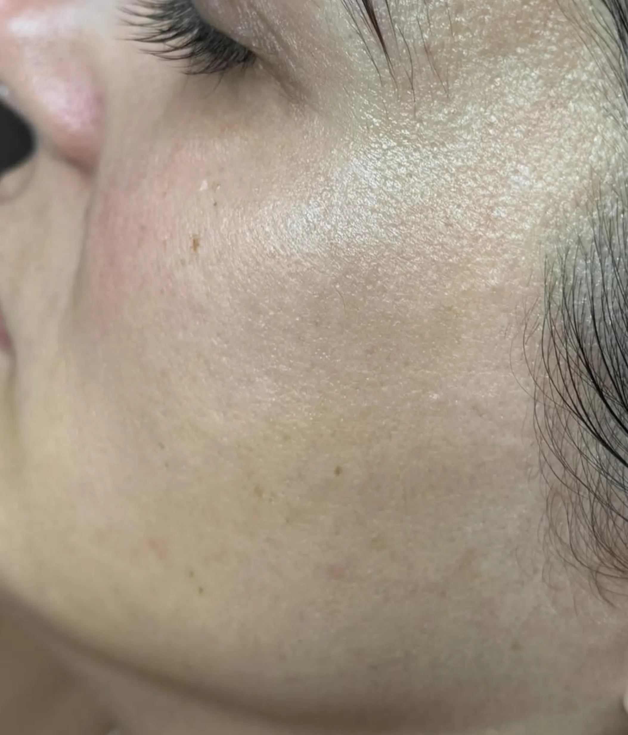acne congestion treatment plan