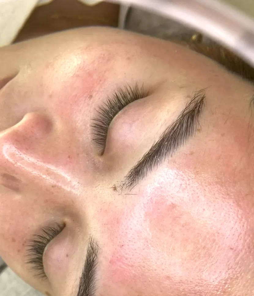 How To Get 100% Clear Skin?