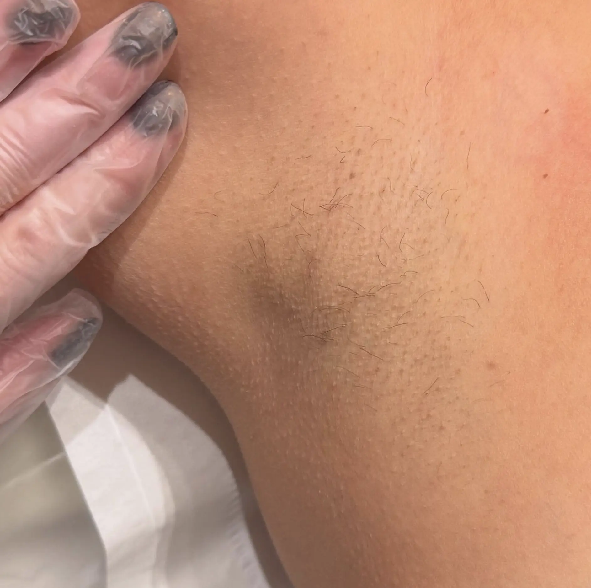 laser hair removal course melbourne