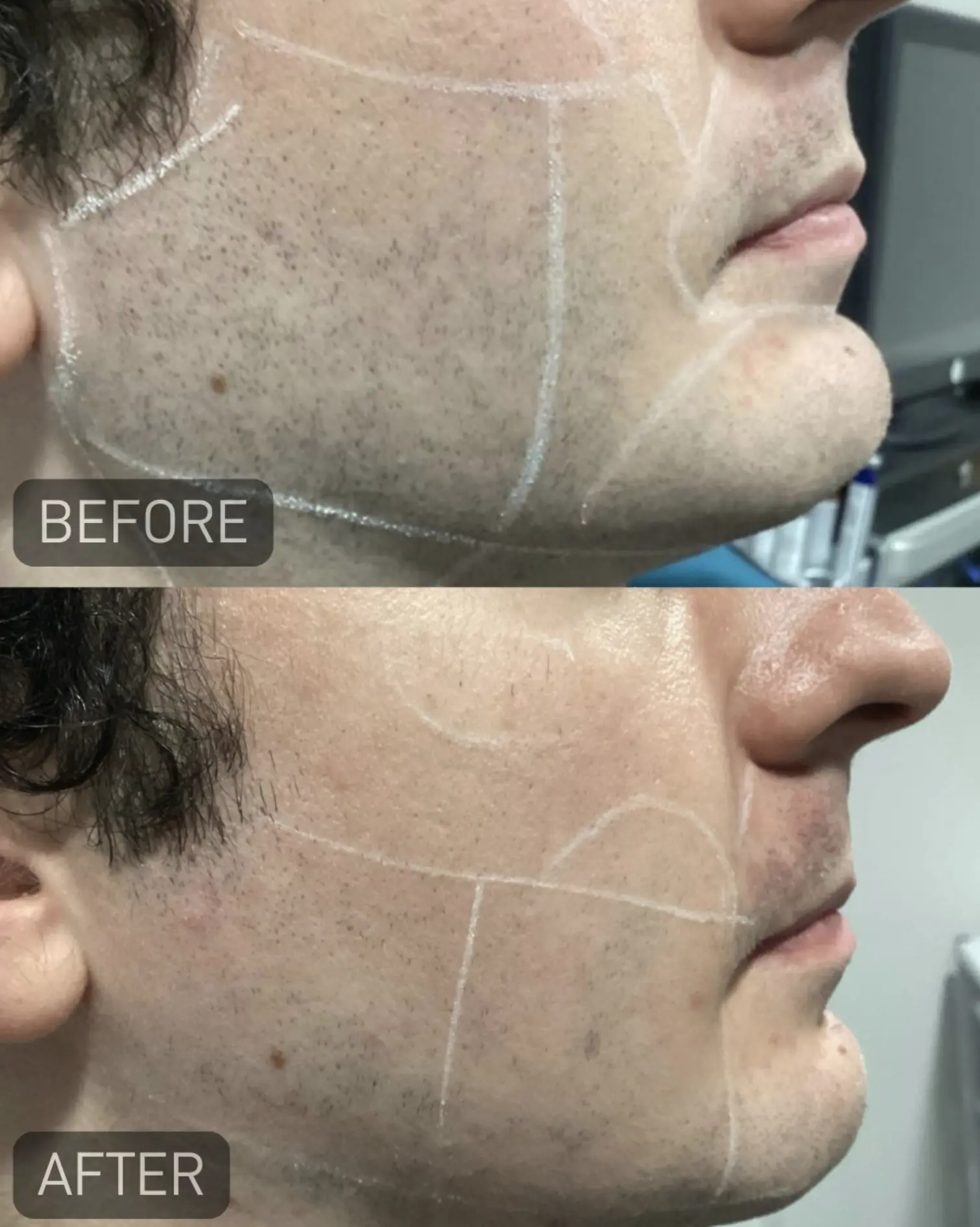 laser hair removal course