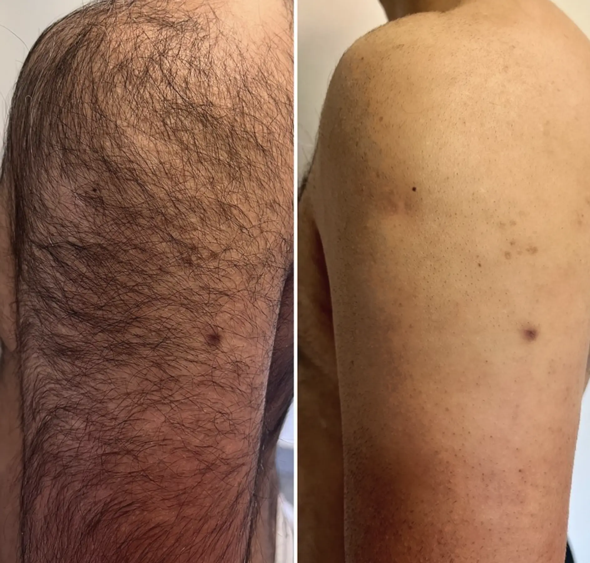 laser hair removal questions